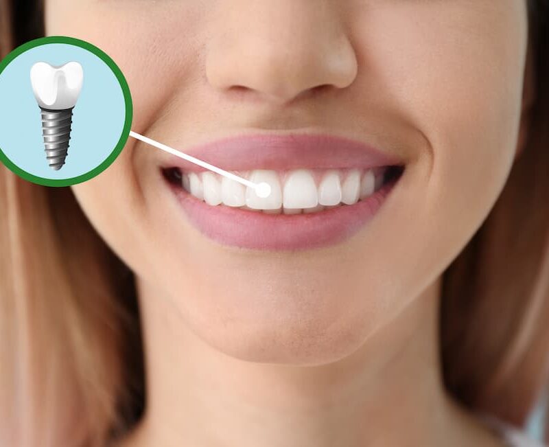 Pebble Beach Dental Implants