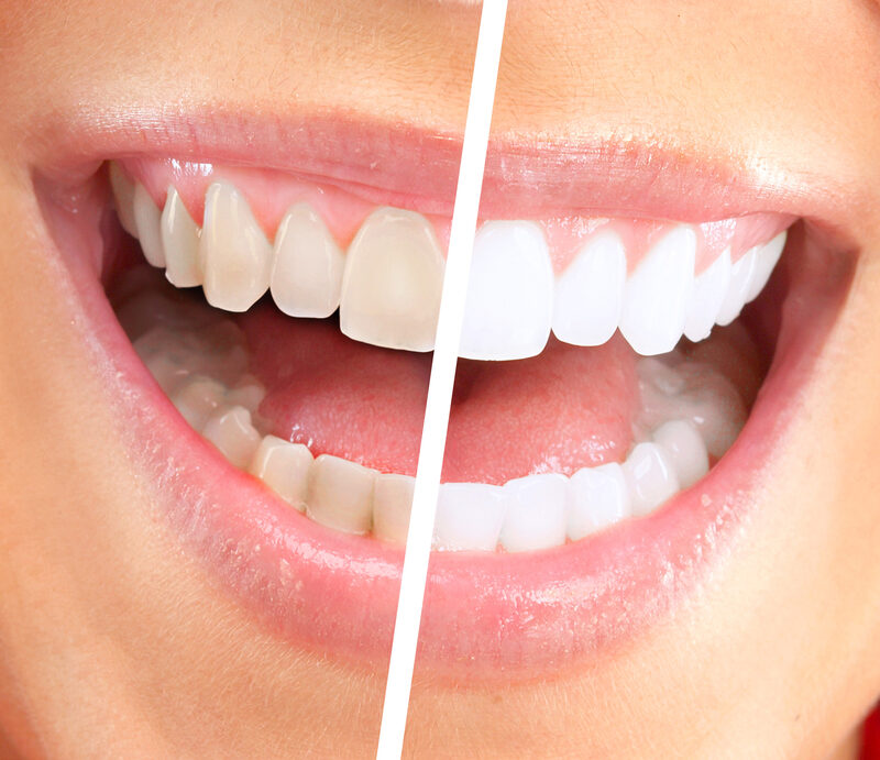 cosmetic dentistry before and after