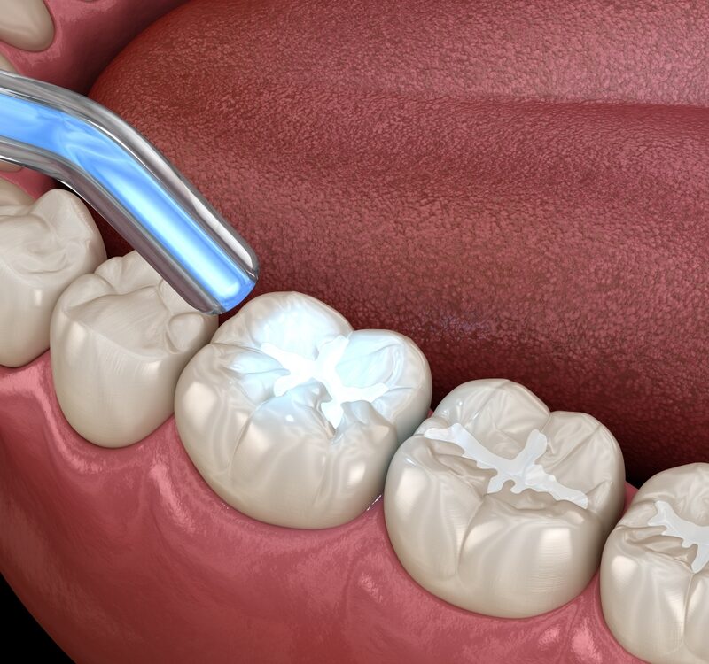 Tooth,Restoration,With,Filling,And,Polymerization,Lamp.,Dental,3d,Illustration